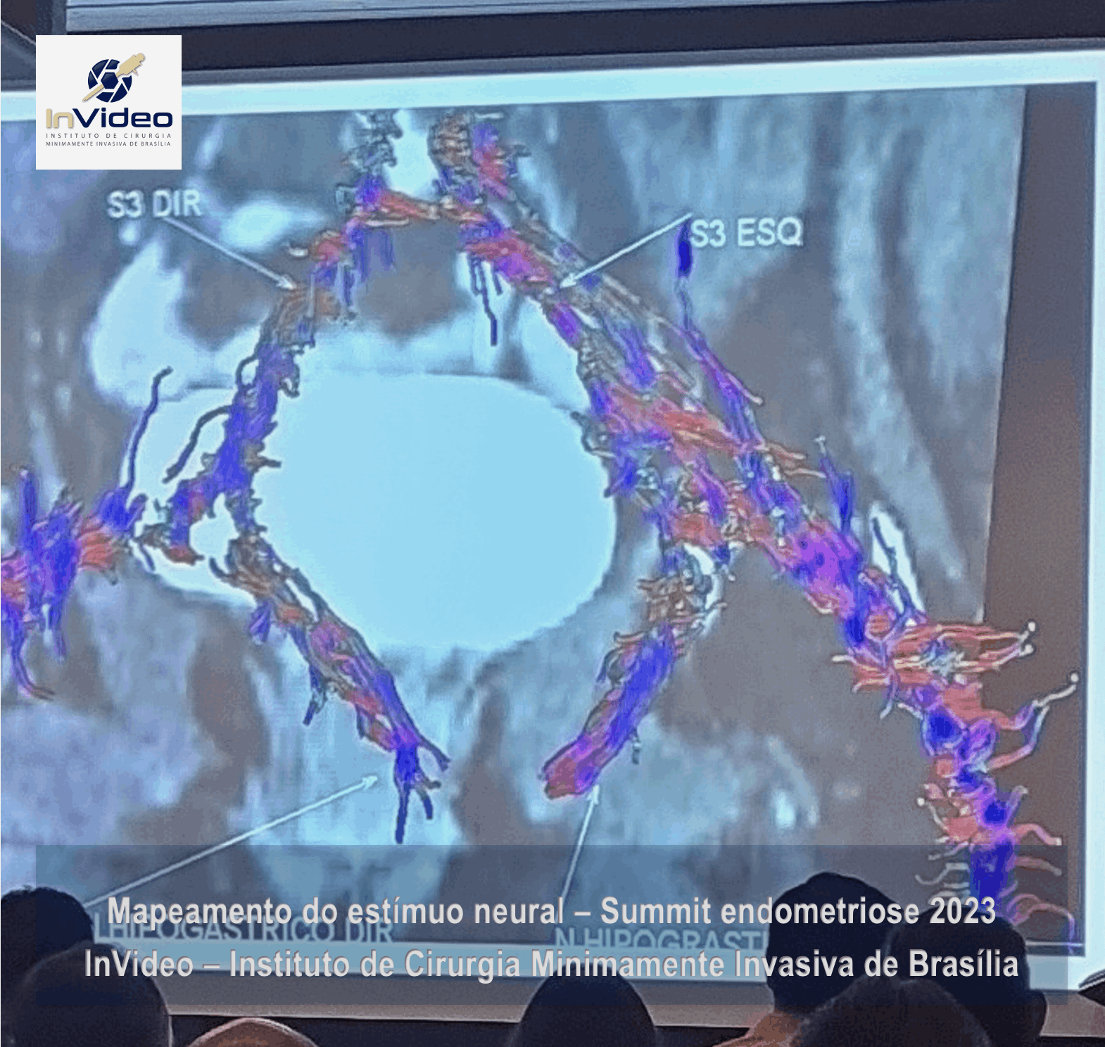 Participação do Dr Leonardo Campbell no Summit Endometriose 2023 - promovido pelo Insituto Johnson & Johnson de ensino e pesquisa e pela Sociedade Brasileira de Endometriose e Cirurgia Minimamente Invasiva - SBE